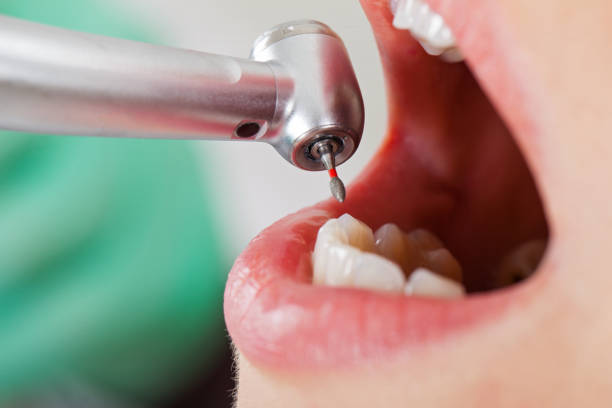 Best Emergency Tooth Extraction in Soap Lake, WA
